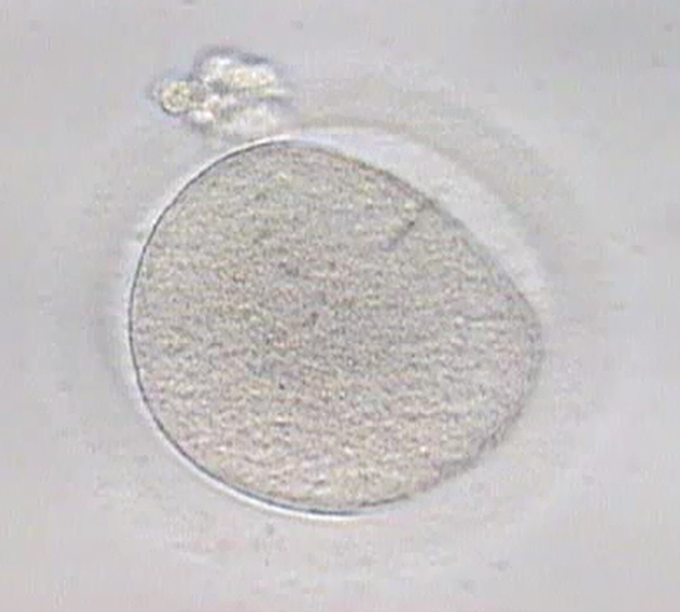 Is it better to use fresh or frozen oocytes in egg donation?