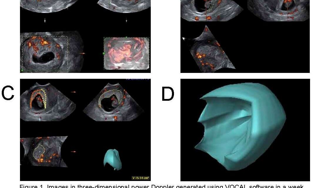 Trophoblastic vascularization study through angiopowerdoppler at week 9 of spontaneous pregnancies and after assisted reproduction techniques