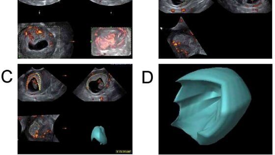 Investigación comparativa de la vascularización en embarazos espontáneos y tras técnicas de reproducción asistida