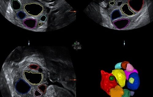 Ovarian cysts: What are they? Symptoms and treatment