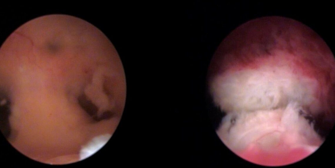 New IB Unit for the Diagnosis and Reproductive Treatment of Asherman’s Syndrome