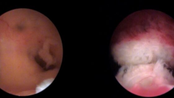 New IB Unit for the Diagnosis and Reproductive Treatment of Asherman’s Syndrome