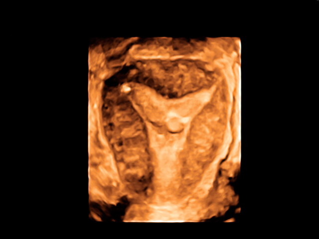Absent uterus or Mayer-Rokitansky-Küster-Hauser syndrome: what can I do?