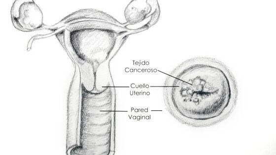 Virus de Papiloma Humano (VPH) y su relación con la infertilidad