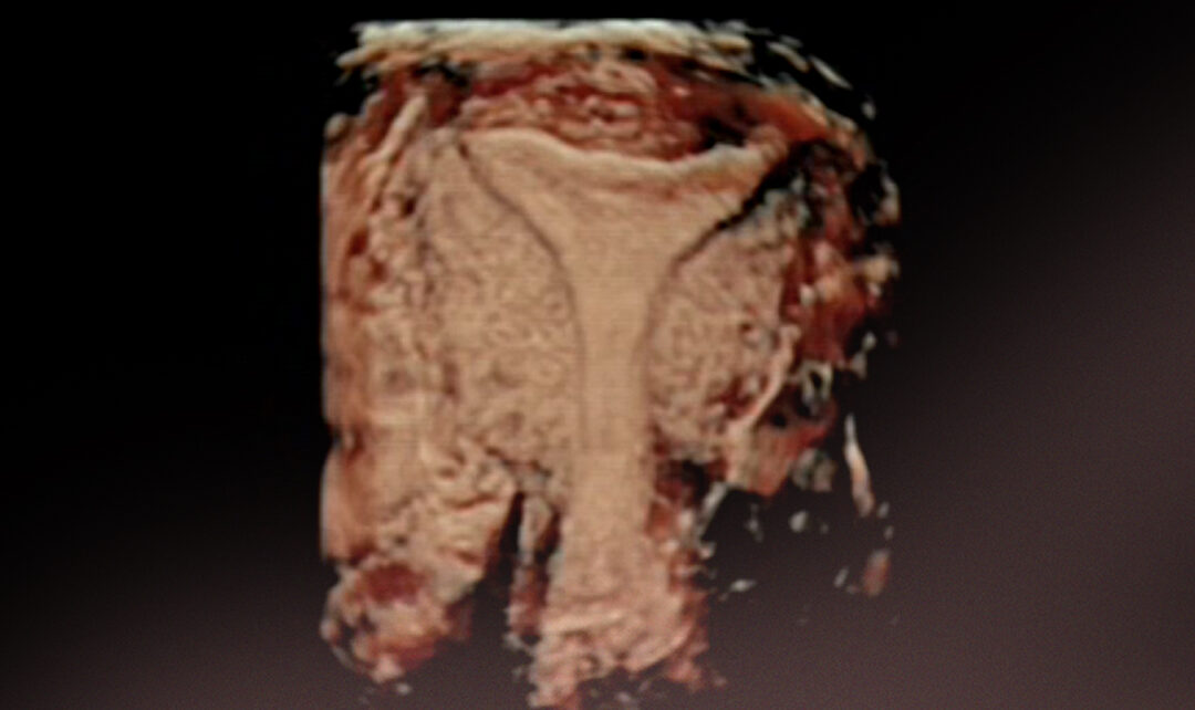 Tipos de test de receptividad endometrial. Pros y Contras