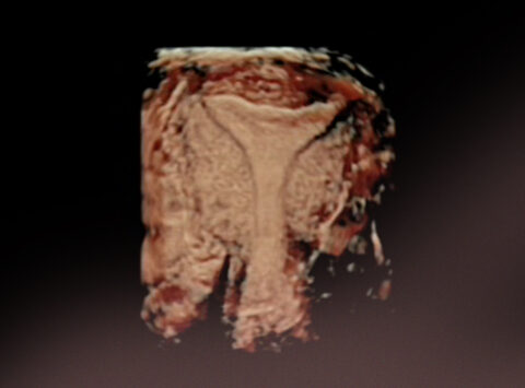 Types of endometrial receptivity test. Pros and cons