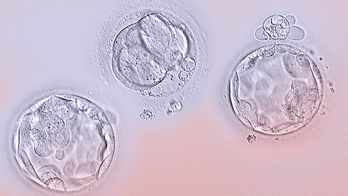 Das Instituto Bernabeu vergleicht das Ergebnis nach dem Transfer von Embryonen im frischen Zyklus und eingefrorenen Embryonen in Zyklen der Eizellspende, die einen Gentest erfordern, um Chromosomenveränderungen zu entdecken