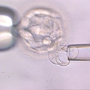 Pre-implantation genetic diagnosis (PGD): comprehensive chromosome screening