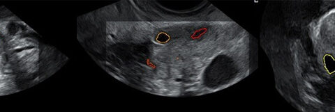 What is a residual follicle? Diagnosis and treatment of a residual cyst