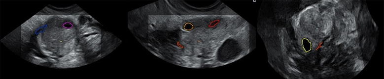 What is a residual follicle? Diagnosis and treatment of a residual cyst