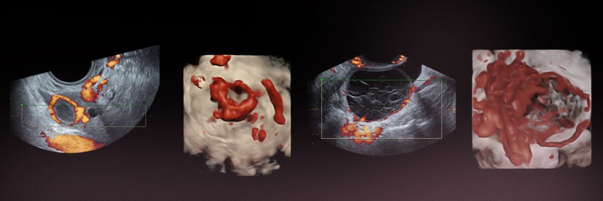 Die Endometriose-Abteilung im Instituto Bernabeu