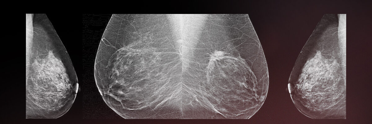 Mammary pathology and mammography