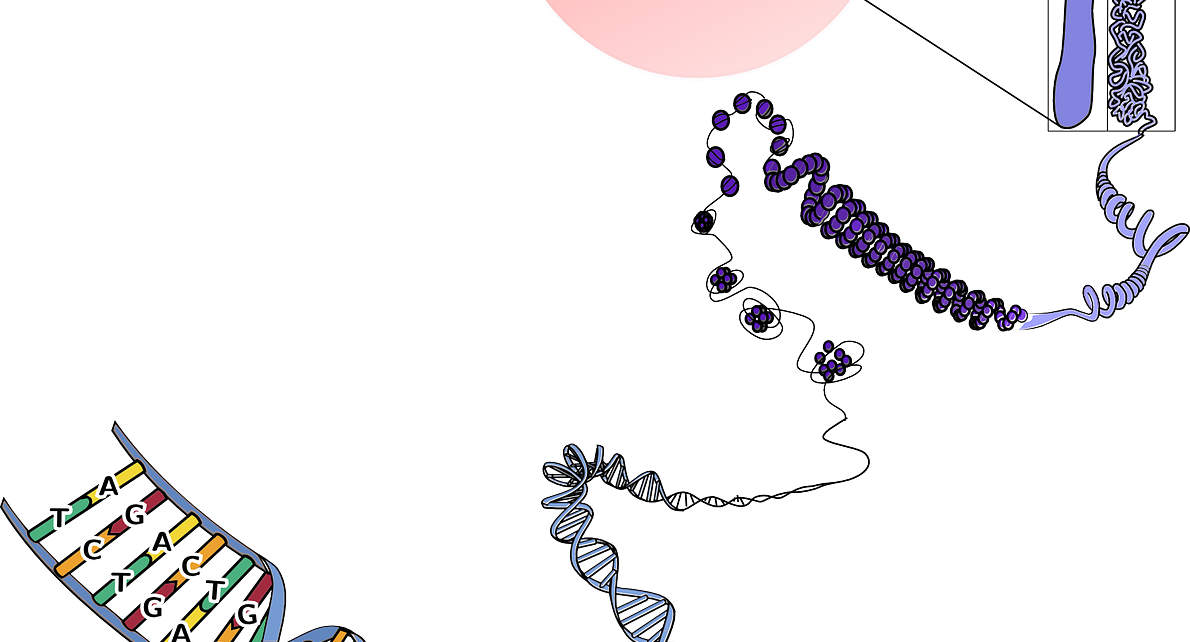 Sindrome di Swyer o disgenesia gonadica pura