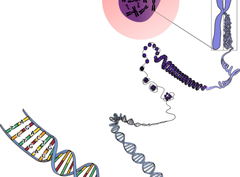 Swyer syndrome or pure gonadal dysgenesis