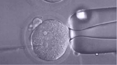 ICSI (Intrazytoplasmatische Spermieninjektion)