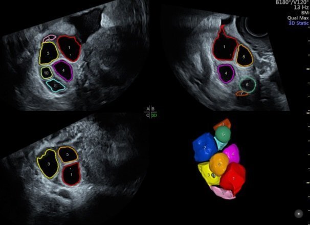 Instituto Bernabeu exposes in the scientific journal Fertility and Sterility the ovary epigenetics in women with low eggs reserve