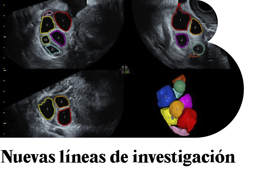 NUEVO IB BOLETÍN. –	Nuevas líneas de investigación para la baja reserva ovárica