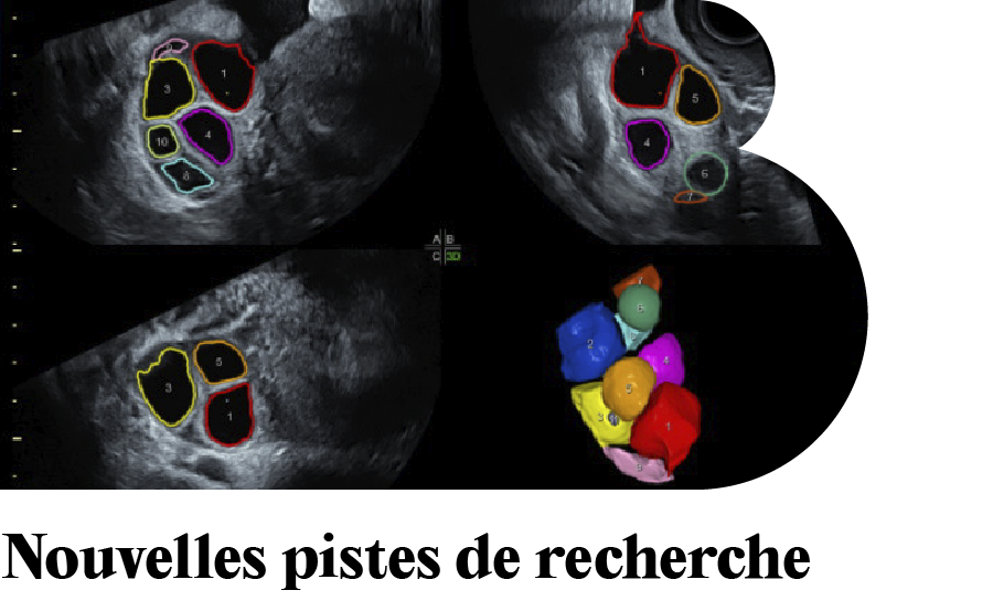NOUVEAU BULLETIN IB: Nouvelles pistes de recherche sur la faible réserve ovarienne