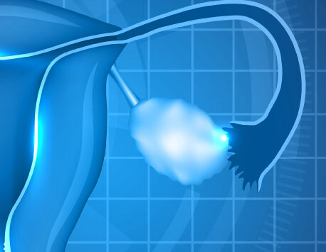 Du rajeunissement ovarien à l’activation folliculaire, stratégies pour les patientes avec faible réserve ovarienne