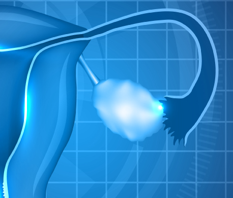 From ovarian rejuvenation to follicle activation, strategies for patients with low ovarian reserve