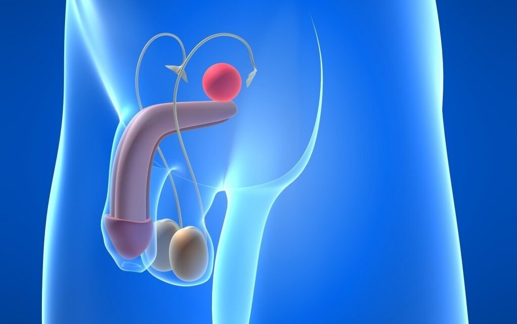 Teratozoospermia and male infertility