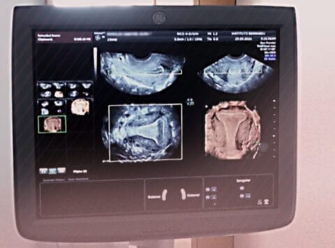 Fertility&Sterility berichtet über eine Studie des Instituto Bernabeu über die Kontraktionen der Gebärmutter mit 4D-Ultraschall für die Diagnose des Implantationsfehlers