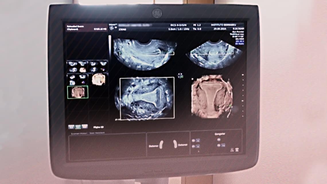 Fertility&Sterility resalta un estudio del Instituto Bernabeu de las contracciones del útero con ultrasonido 4D para diagnosticar fallo de implantación