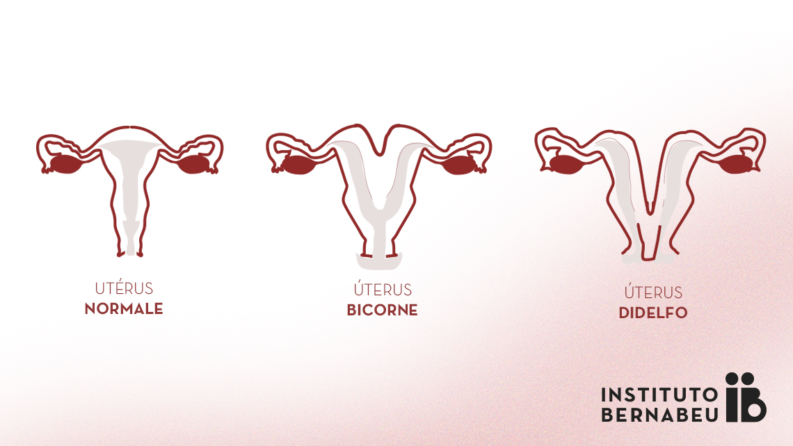 Utérus bicorne, double ou didelphe : Qu’est-ce que c’est ? Comment affecte-t-il la fertilité et la grossesse ?