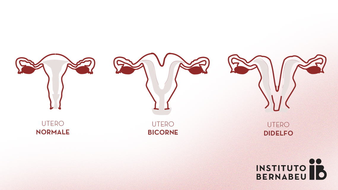 Utero bicorne, doppio o didelfo. Di cosa si tratta? Che effetti ha sulla fertilità o sulla gravidanza