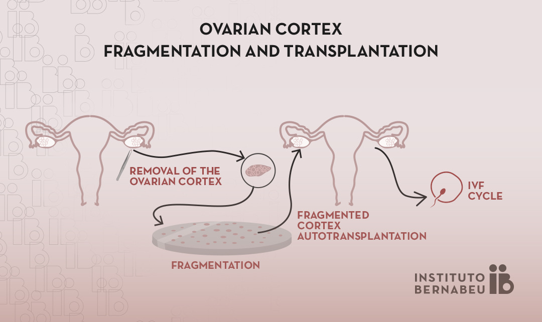 Ovarian rejuvenation through fragmentation and transplantation of ovarian cortex