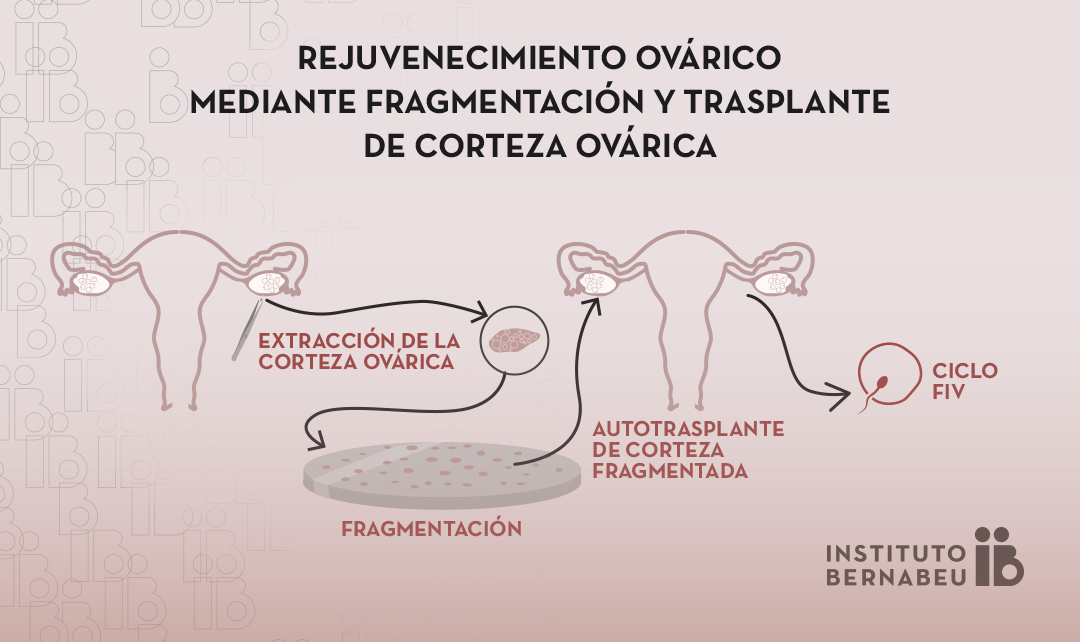 Rejuvenecimiento ovárico mediante fragmentación y trasplante de corteza ovárica