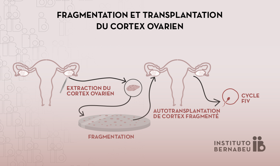 Rajeunissement des ovaires par la fragmentation et la greffe de cortex ovarien