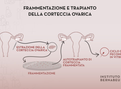 Ringiovanimento ovarico mediante frammentazione e trapianto della corteccia ovarica