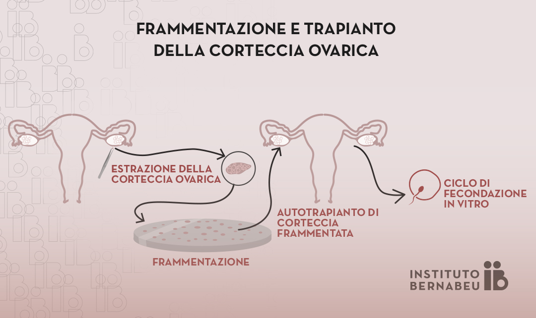 Ringiovanimento ovarico mediante frammentazione e trapianto della corteccia ovarica