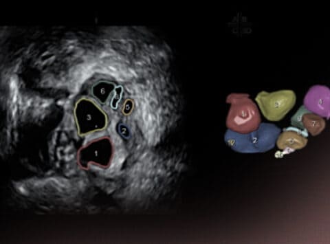 Basal ultrasound scan: antral follicle count to determine ovarian reserve