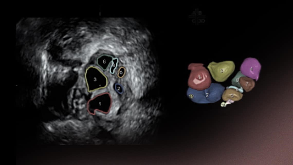 Basal ultrasound scan: antral follicle count to determine ovarian reserve