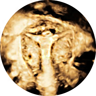 L’isterosalpingografia (HSG) è un’analisi che tradizionalmente si usava per studiare le tube e l’utero. Richiede l’uso di raggi X e di un mezzo di contrasto iodato. 