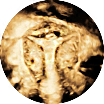 L’isterosalpingografia (HSG) è un’analisi che tradizionalmente si usava per studiare le tube e l’utero. Richiede l’uso di raggi X e di un mezzo di contrasto iodato.