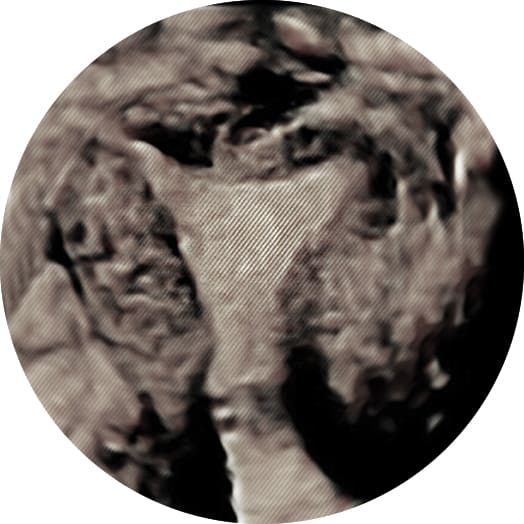 In Reproductive Medicine we pay a lot of attention to primarily the post ovulatory phase, since it can show reasons for implantation failure. It is important that the measurements and the visualization of the endometrial line should be done properly, and the sonographers experience as well as the machine used could play a role in incorrect diagnosis. Because of this the use of three dimensional ultrasound is quite promising. It allows us to not only evaluate the endometrial size on one plane, but the total endometrial volume and a study of the vascularization that feeds the endometrium, which is fundamental in uterine receptivity.