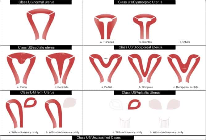 La imagen tiene un atributo ALT vacío; su nombre de archivo es ESHRE-ESGE-classification-of-uterine-anomalies-schematic-representation-Class-U2.jpg