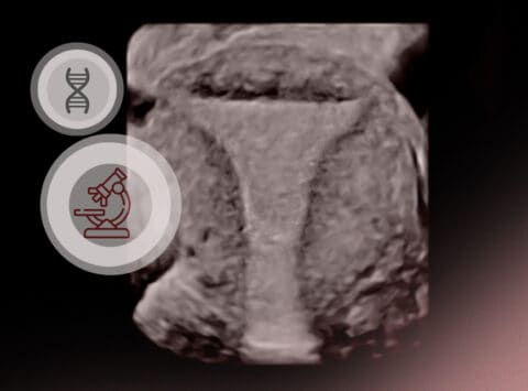 Endometriose: Neue Errungenschaften bei der Diagnose (immunologische und genetische Marker)