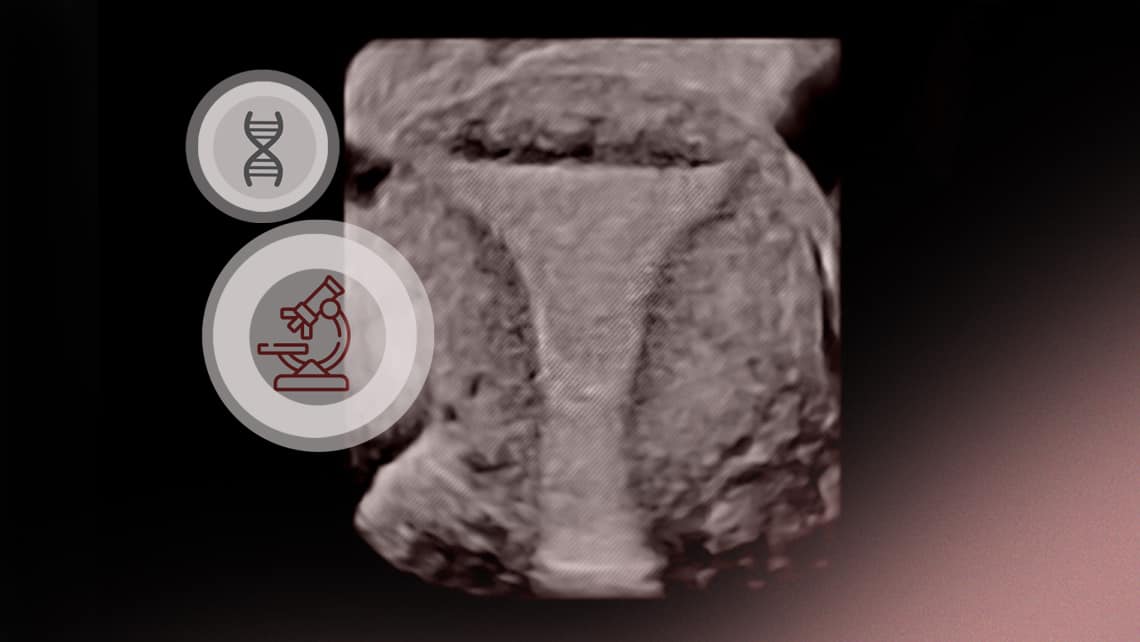 Endometriose: Neue Errungenschaften bei der Diagnose (immunologische und genetische Marker)