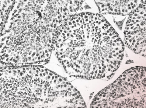 Infecciones en el testículo o aparato reproductor que pueden ocasionar infertilidad masculina: Epididimitis, Orquitis e ITS