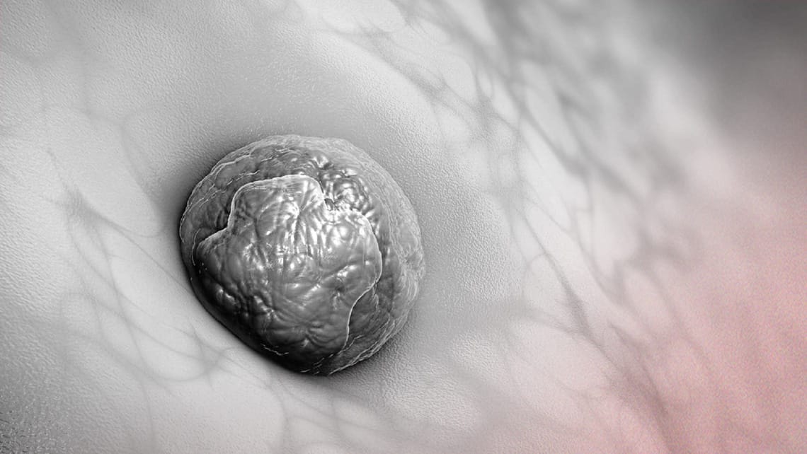 What are the main causes of embryo implantation failure? 