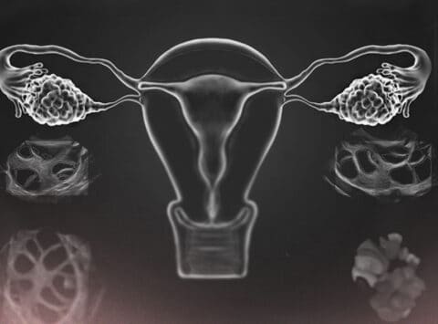 Non rispondo alla stimolazione ovarica in un ciclo di fecondazione in vitro (FIVET), cosa posso fare?