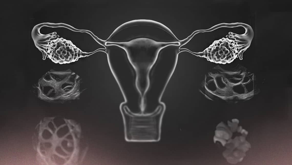 No respondo a la estimulación ovárica en un ciclo de fecundación in vitro (FIV), ¿qué puedo hacer?