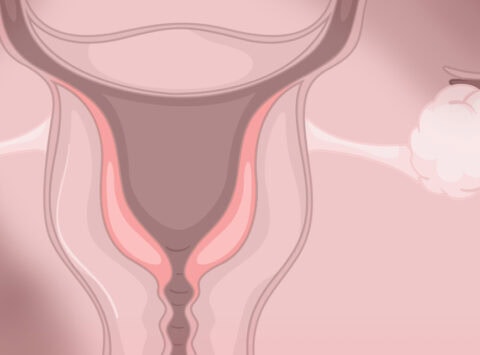 Cómo se diagnostica la endometriosis: pruebas médicas y tiempos