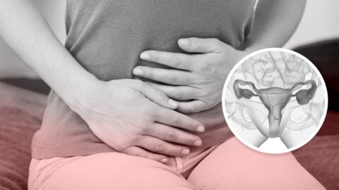 Varices uterinas y ováricas: síntomas, causas y tratamiento del síndrome de congestión pélvica