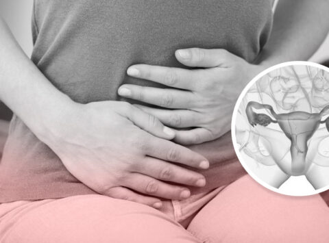 Varices uterinas y ováricas: síntomas, causas y tratamiento del síndrome de congestión pélvica